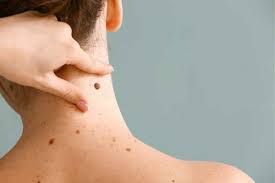 Your Guide to Professional Skin Tag Removal in London in 2025